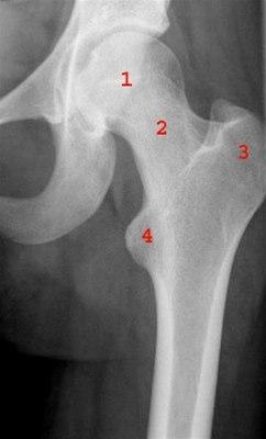Røntgenbilde av normalt hofteledd.