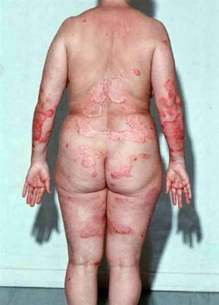 Psoriasis