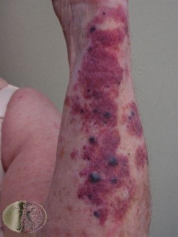 Fotoet viser hemangiom, voksen