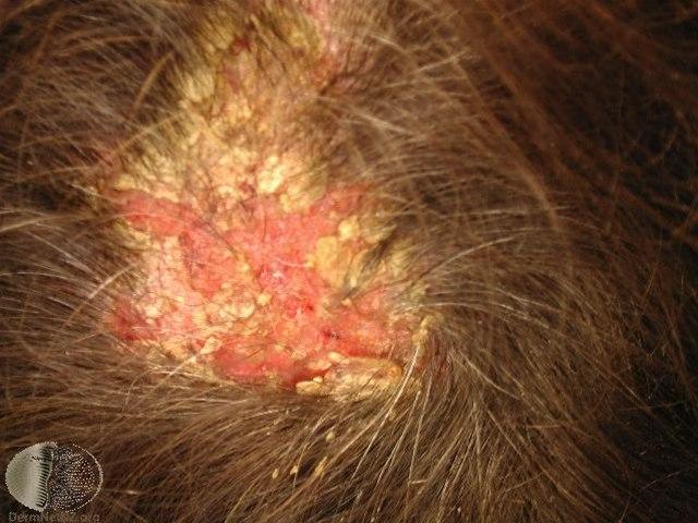 Fotoet viser pemfigus vulgaris