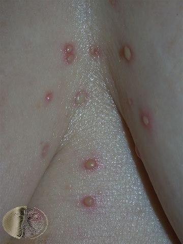 Fotoet viser blemme i huden, pustel