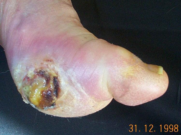 Infisert diabetisk fotsår.