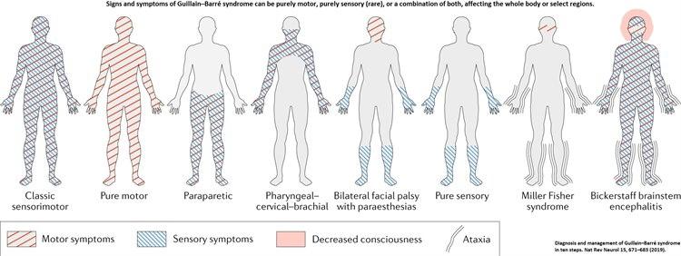 Guillain_Barre_Patterns.jpg