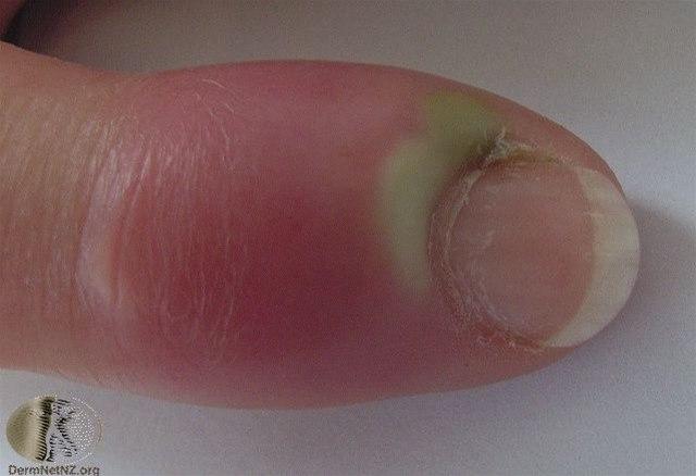 Fotoet viser paronykia, akutt reaksjon
