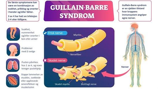 Guillain-barre syndrome