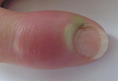 Paronychia, acute reaction