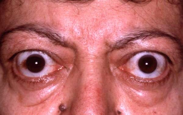 Frontalt bilde som viser eksoftalmus.