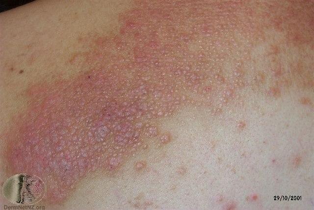 Fotoet viser nevrodermatitt