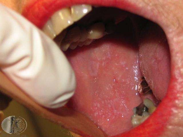 Fotoet viser lichen planus, oral