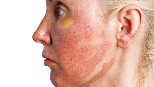 Sideprofil av et ansikt med brannskader