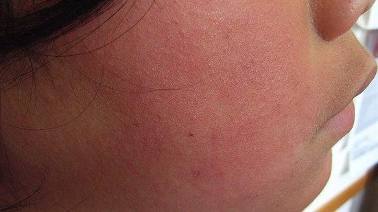 Fotoet viser et kinn til et barn med utslett