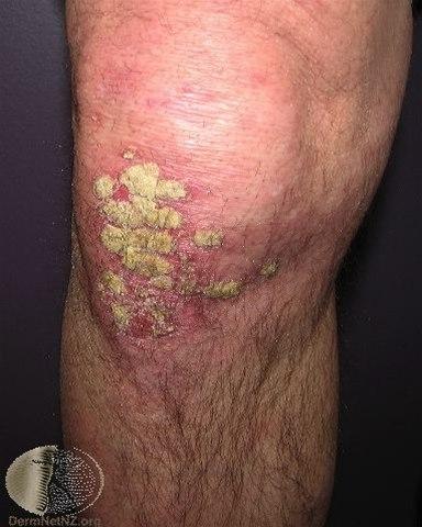 Fotoet viser psoriasis på et kne