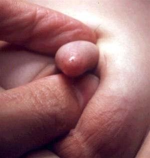 Trang forhud. US Centers for Disease Control and Prevention.