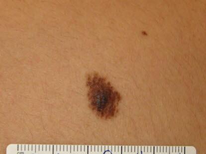 Nevus, irregulær