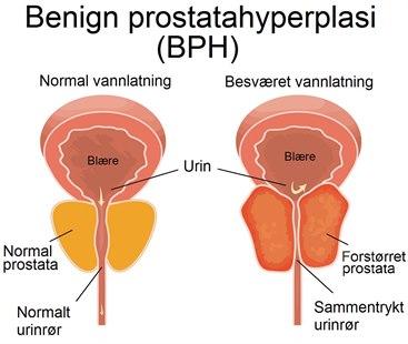 BPH