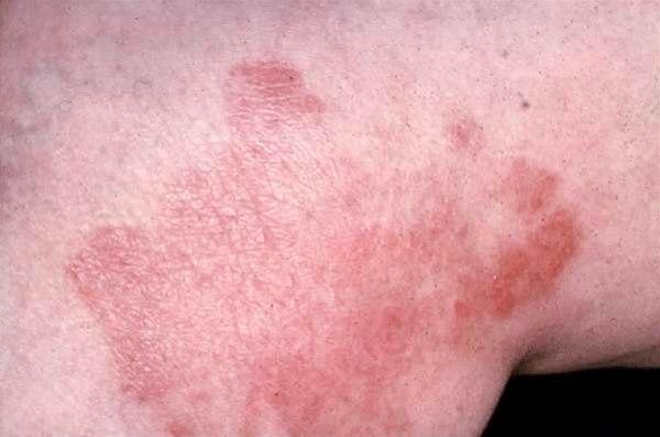 Neurodermitis chronica circumscripta.