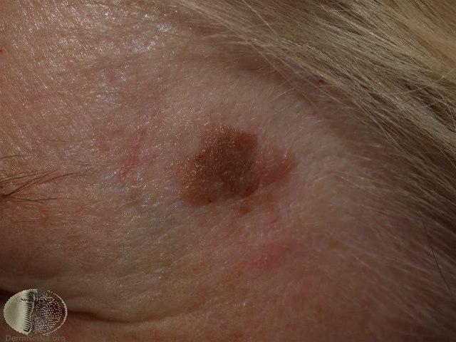 Fotoet viser seboroiske vorte