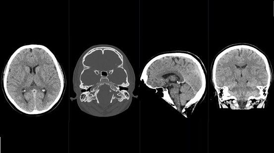 CT bilde av hjernen som viser normale forhold hos en ung mann
