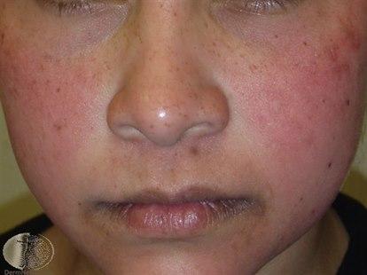 Ansikt til liten gutt med rødmusset hud og oppklarning/blekhet rundt nese og munn