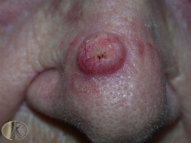 Fotoet viser keratoakantom, nese