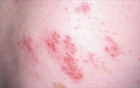 herpes zoster, lumbal ikke bruk