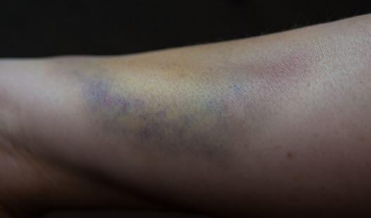 Illustrasjonsfoto av en blåflekk som har både gul, blå og lilla nyanser