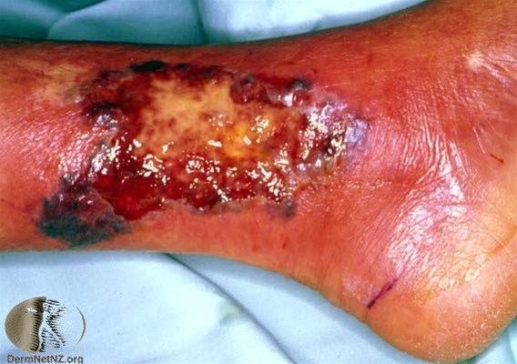 Fotoet viser pyoderma gangrenosum