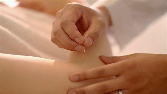 Terapeut stikker akupunkturnål inn i huden til en pasient.