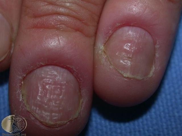 Fotoet viser paronykia