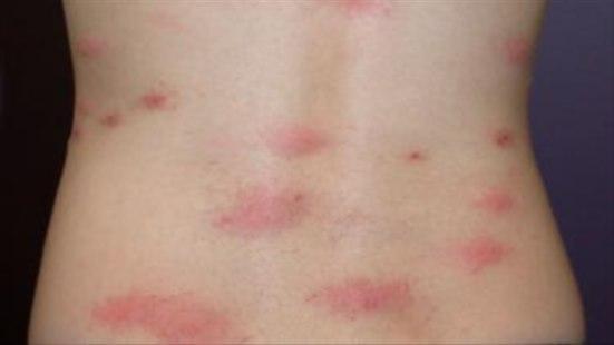 Fotoet viser nærbilde av ryggtavlen til ungdom som viser klase med ca. 10 store og hissige loppebitt