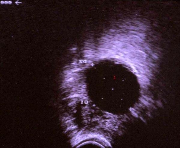 Enkamret, ekkofattig cyste