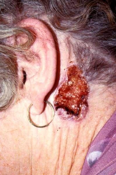 Basalcellecarcinom av nodulær type. Stor ulcerasjon (Ulcus rodens) med karakteristisk vollformet kant med teleangiektasier.