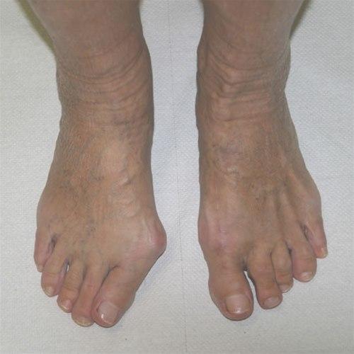 Hallux valgus før og etter operasjon.