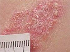 Psoriasis plakk