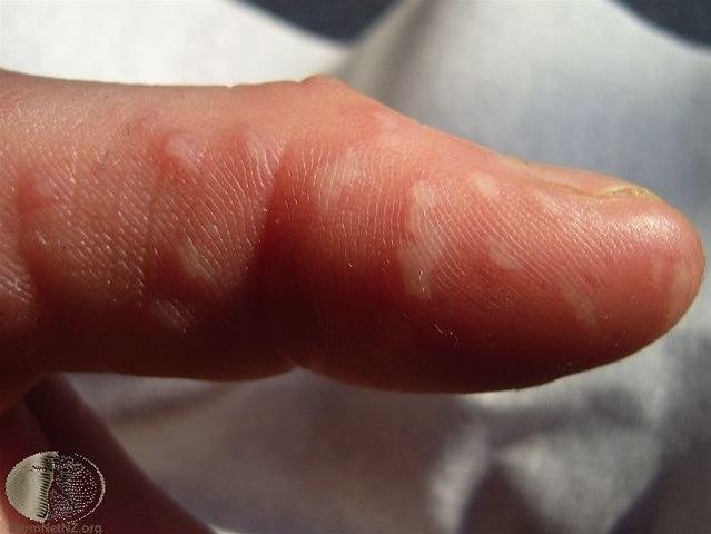 Fotoet viser hånd-, fot- og munnsykdom 1