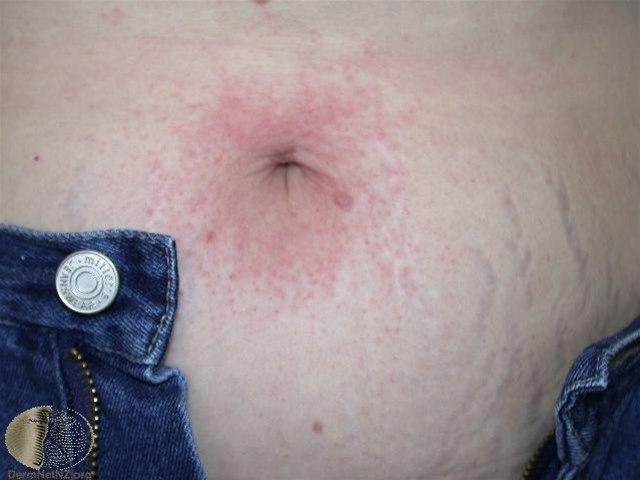 Fotoet viser kontakteksem, nikkelallergi