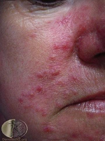 Fotoet viser rosacea, alvorlig