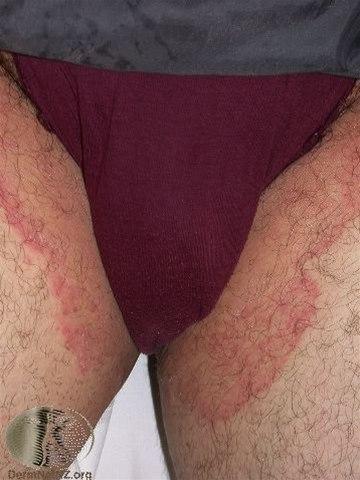 Fotoet viser tinea cruris rundt trusekanten  