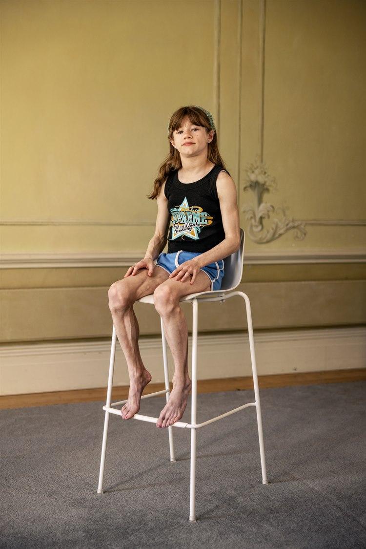 Illustrasjonsfoto viser yngre person med lipodystrofi