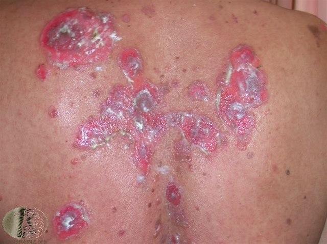 Fotoet viser pemfigus vulgaris