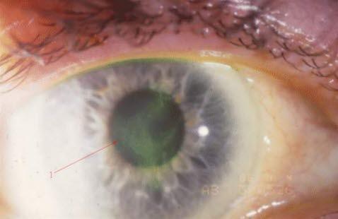 Keratitis dendritica