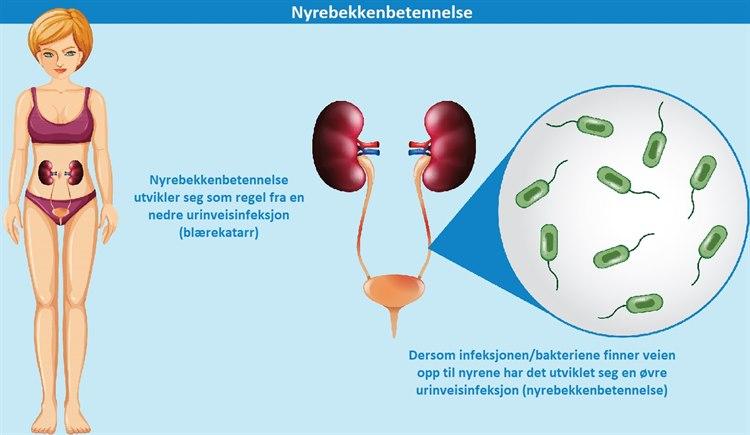 Illustrasjonen viser urinveiene og hvordan bakterier kan spre seg fra blæren til nyrene og gi nyrebekkenbetennelse.