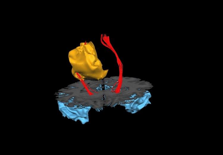 Diffusjons- MR- Et eksempel der der det ikke er mulig å operere bort svulsten uten å skade nervetrådene.