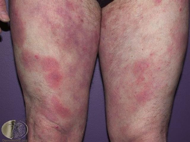 Fotoet viser mycosis fungoides, flekker på lår