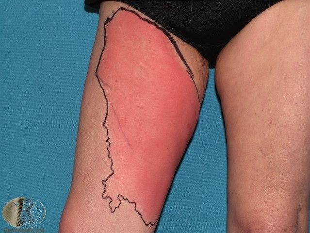 Fotoet viser cellulitt 