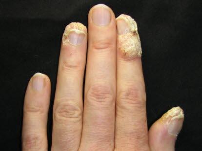 Fotoet viser onycholysis, at negleplaten er separert fra neglesengen, kan skyldes lokale problemer som periunguale vorter