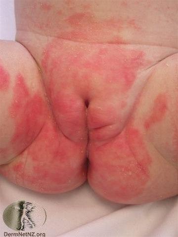 Fotoet viser bleiedermatitt, vanlig