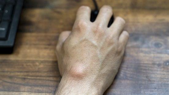 Fotoet viser en hånd som holder på en datamus. Ved håndleddet ses et ganglion