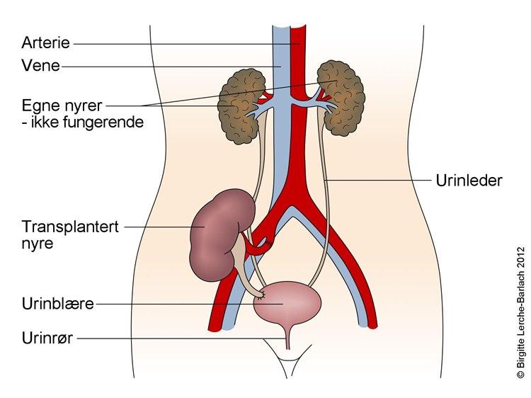 Transplantert nyre