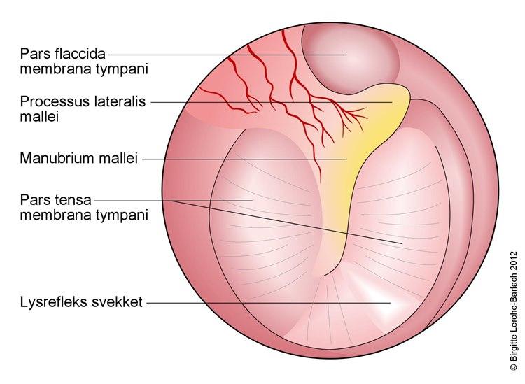 Trommehinnen sett via øregangen.